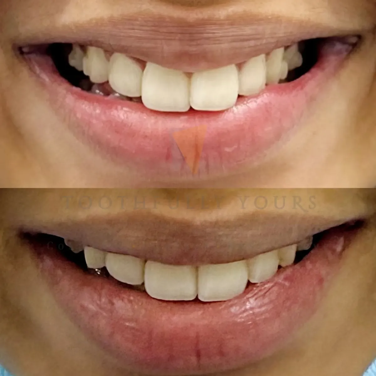 Before and after