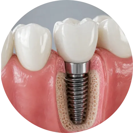 Dental Implants