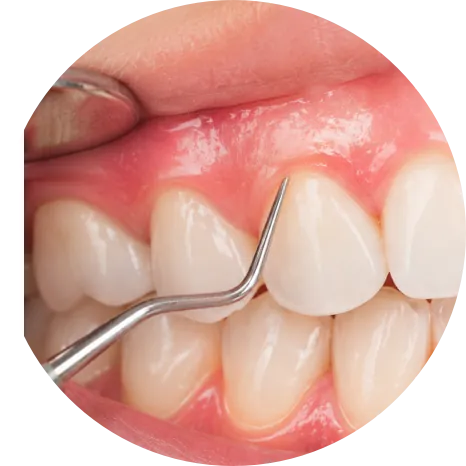 Gum Treatment