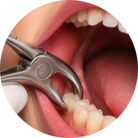 Tooth Extraction